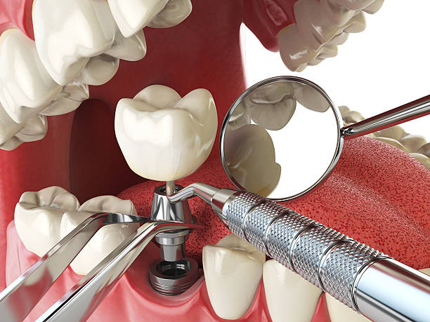 Best Chipped Tooth Repair Near Me  in , IA